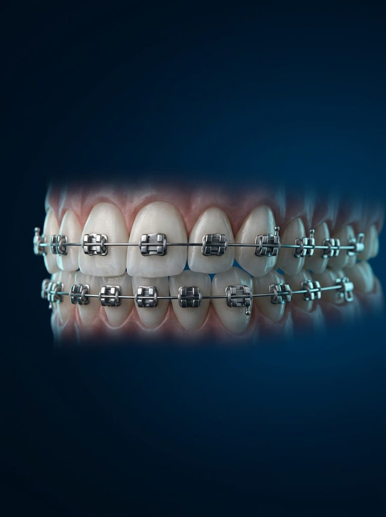 Braces