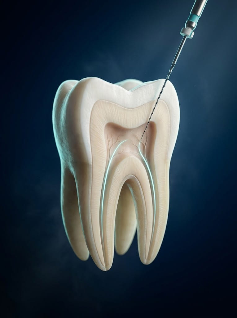 Root Canal Treatment