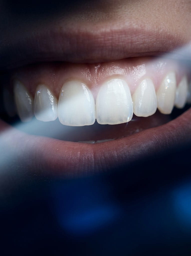 Teeth Whitening